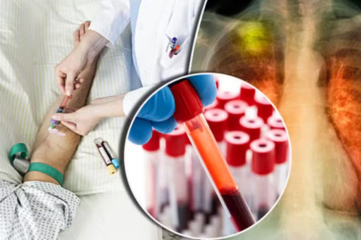 New Blood Test Could Predict Lung Cancer Risk Up to Five Years Before Diagnosis
