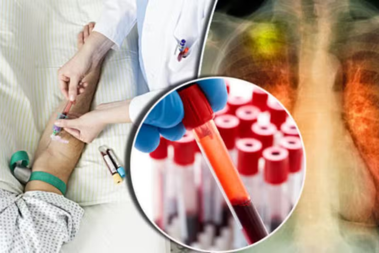 New Blood Test Could Predict Lung Cancer Risk Up to Five Years Before Diagnosis