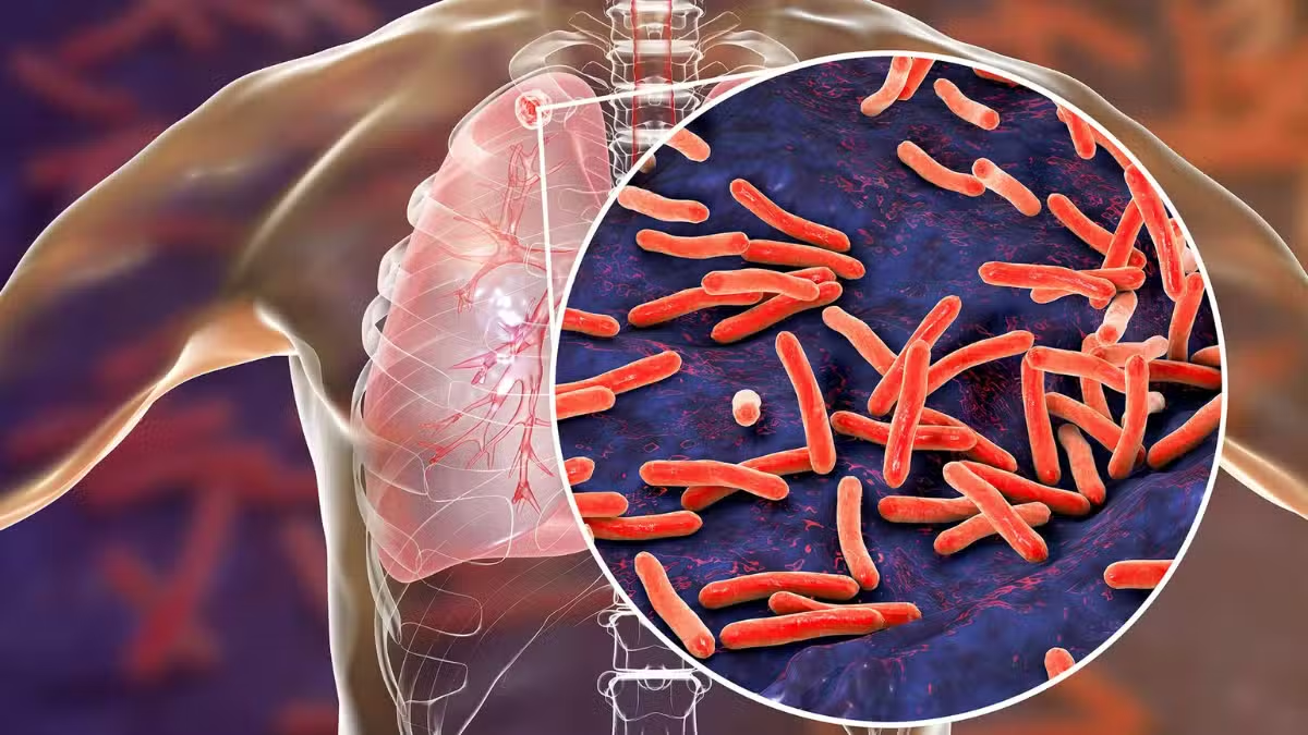 Rs. 1,100 Portable Device Can Detect Tuberculosis in Just 30 Minutes Across Pakistan