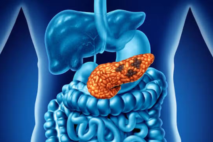 FDA Approves New Pancreatic Cancer Pill After Trial Shows Survival Benefits